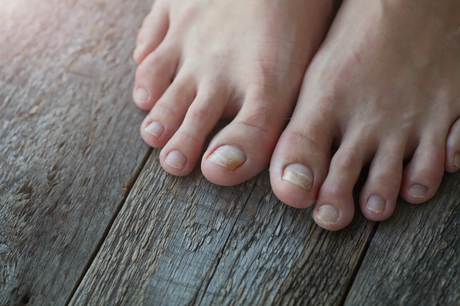 Toenail Surgery 1