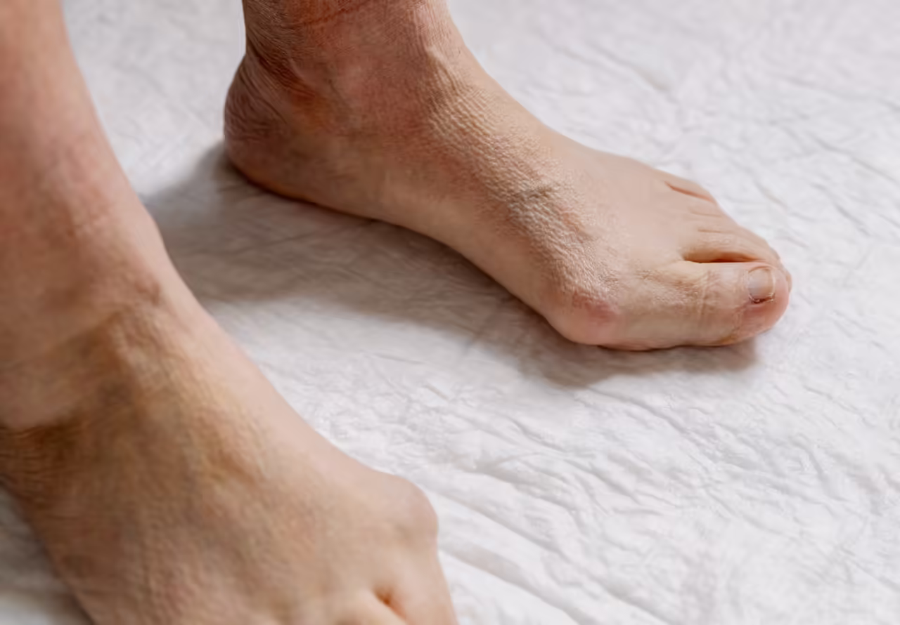 hallux valgus on senior adult foot 2026 03 25 08 11 23 utc